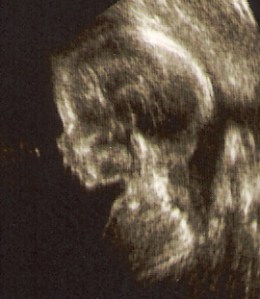 Caroline sonogram